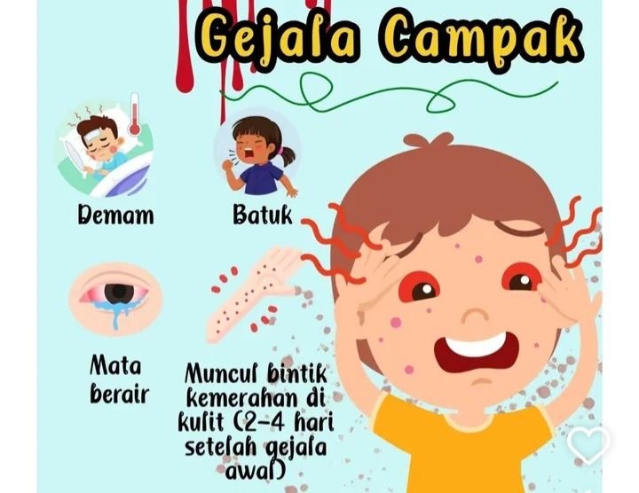 Campak Mewabah di Sumenep, 17 Orang Meninggal